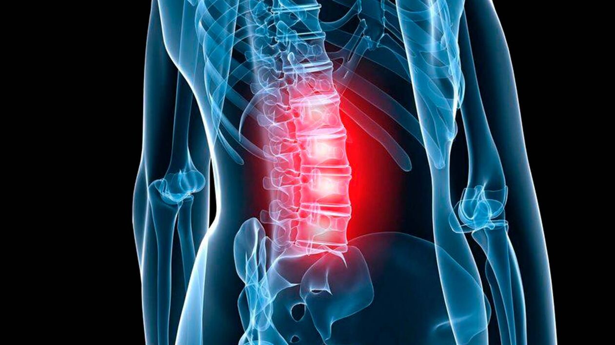 simptomi ledvene osteohondroze