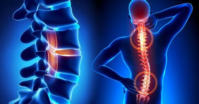 lokalizacija bolečine pri osteohondrozi
