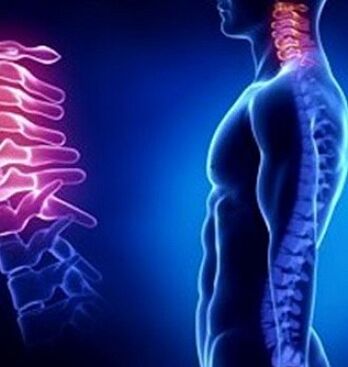 Cervikalna osteohondroza je lahko posledica poškodb vratu